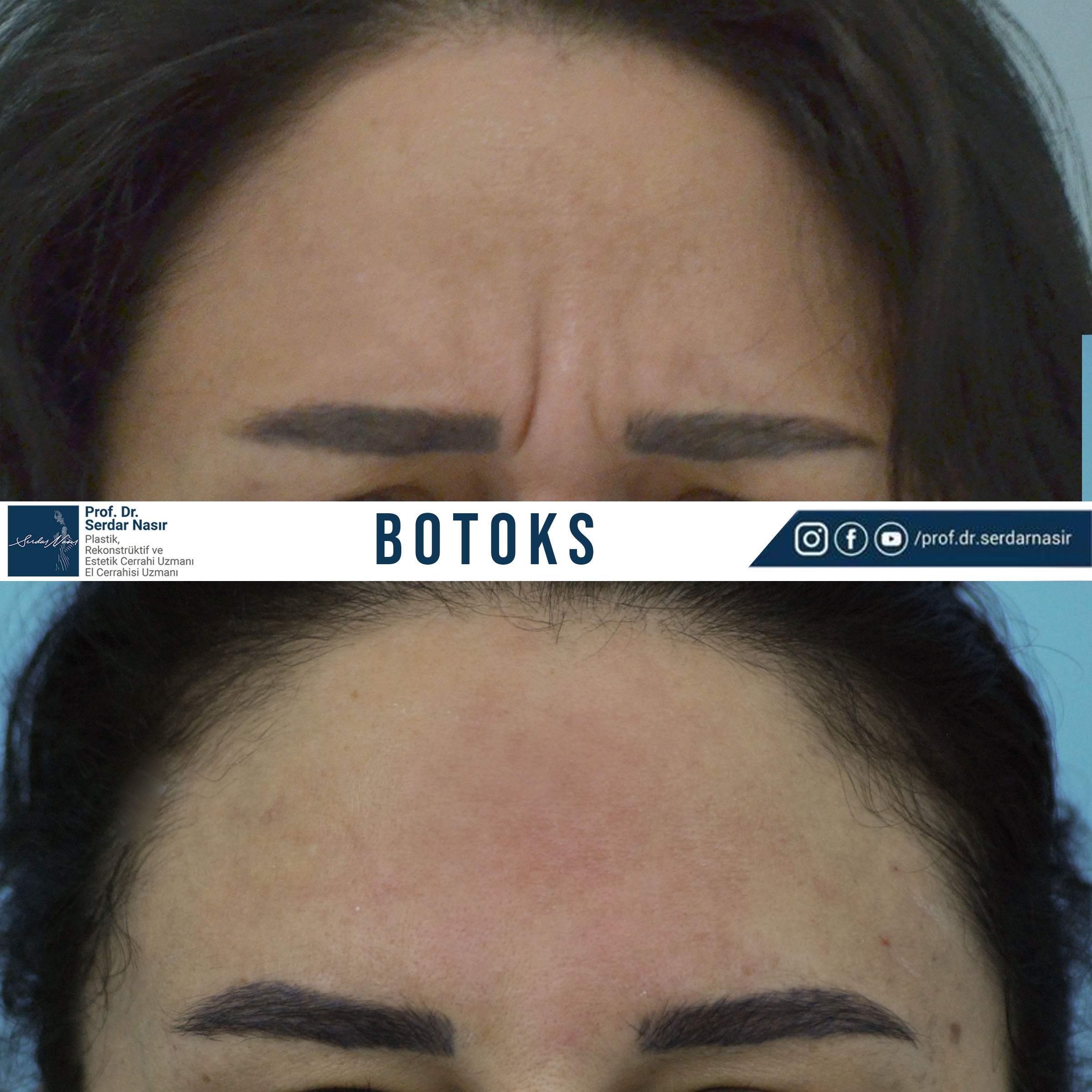 botoks (2)
