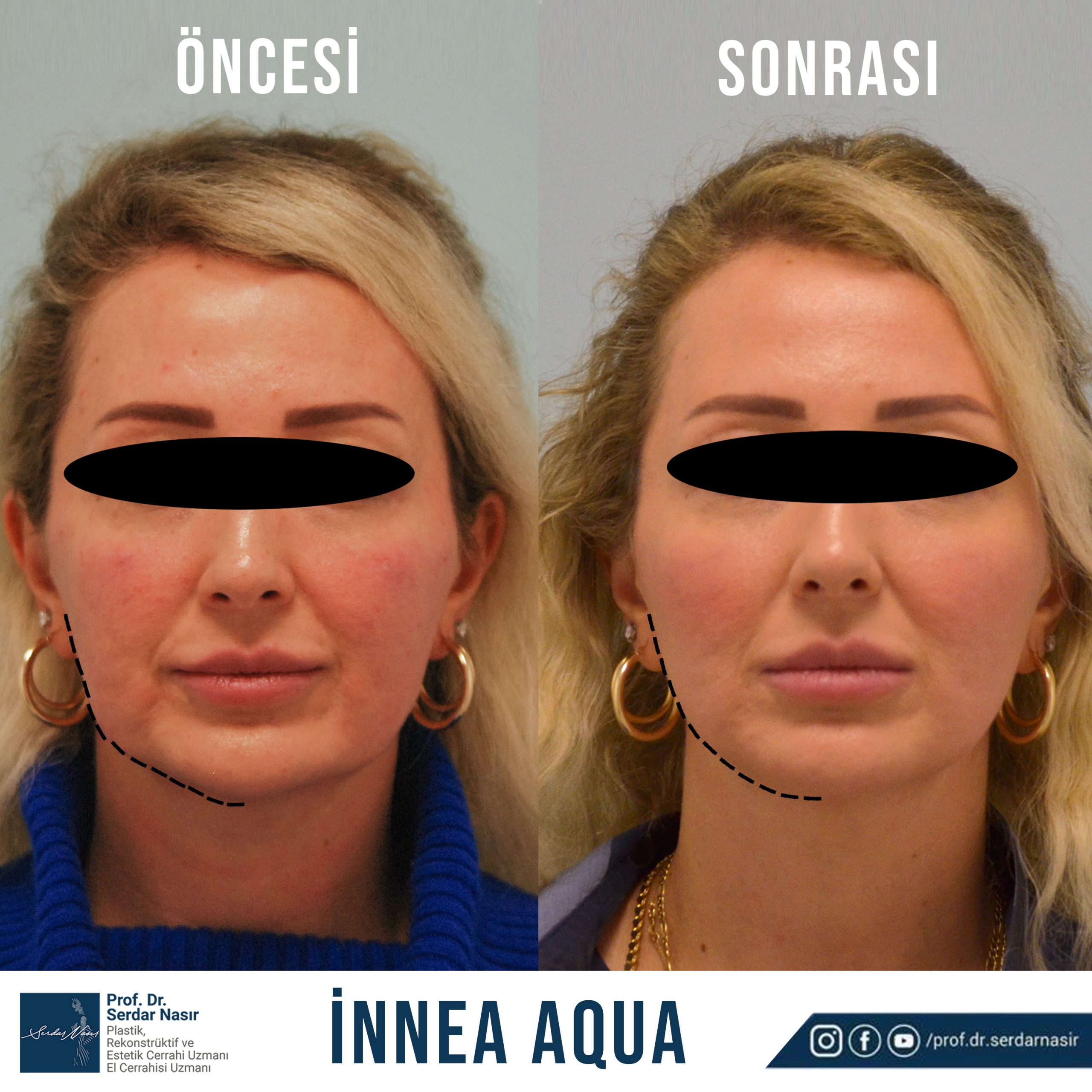 innea1