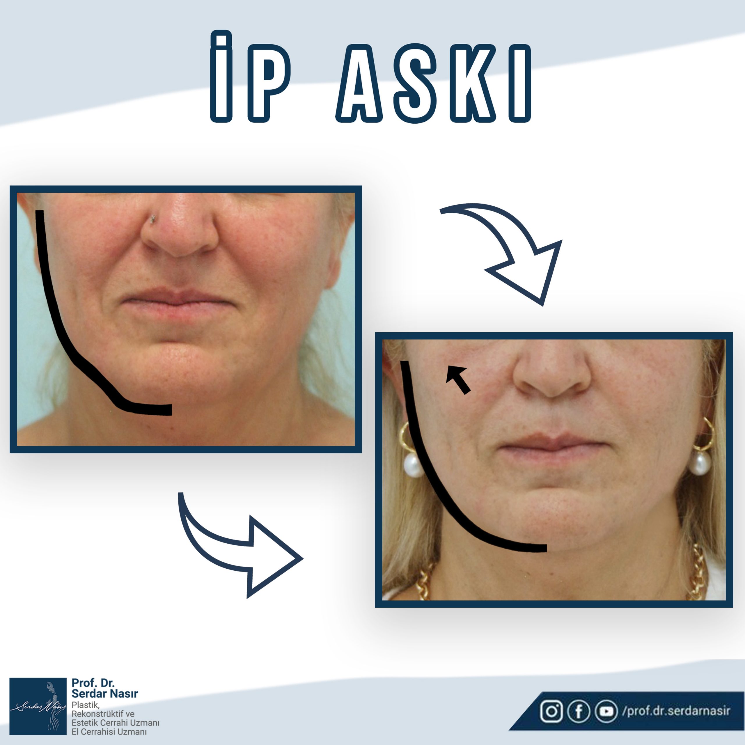 ip
