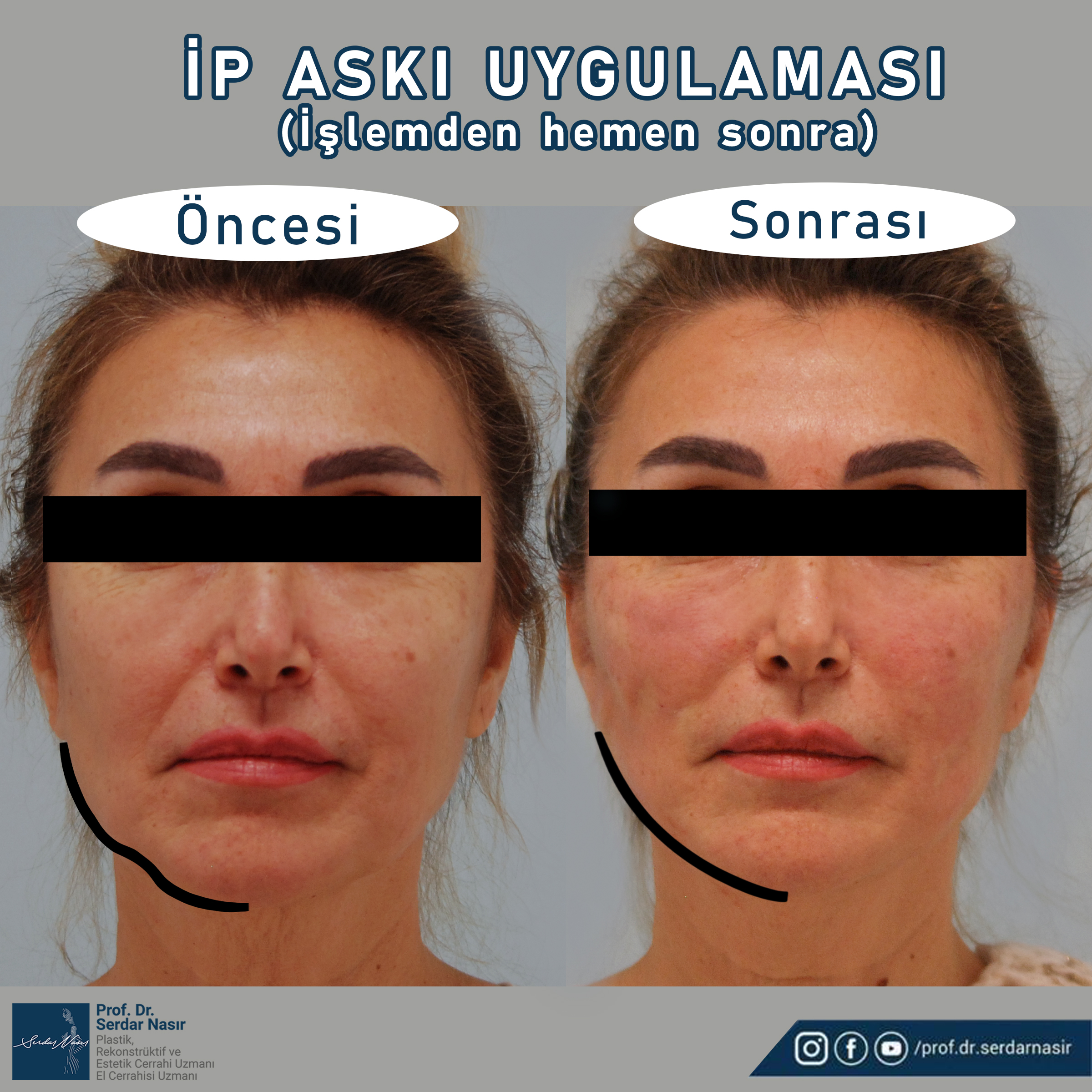 ip3222